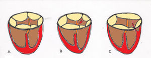 Clasificación de Rastelli del canal auriculoventricular completo. En el canal tipo A el velo puente superior está dividido y tiene inserciones tendinosas en la cresta del tabique interventricular. En el canal tipo B, el velo puente superior está dividido y se inserta en un músculo papilar accesorio a la derecha del tabique interventricular. El canal tipo C presenta un velo puente superior de gran tamaño o no dividido que se inserta en un músculo papilar anterior del ventrículo derecho.