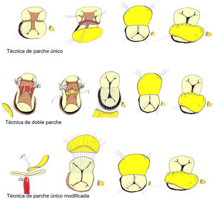 Técnicas de reparación del canal auriculoventricular completo.
