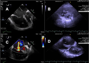 A) Imagen de ecocardiograma transesofágico intraoperatorio. Se observa gran dilatación de cavidades derechas. La flecha blanca señala el músculo papilar único. B) Imagen de ecocardiograma transtorácico preoperatorio subcostal corto. La flecha negra señala el músculo papilar único. C) Imagen de ecocardiograma transesofágico intraoperatorio. Se identifica insuficiencia tricúspide severa. D) Imagen de ecocardiograma transtorácico preoperatorio paraesternal eje largo. La flecha negra indica el músculo papilar único.