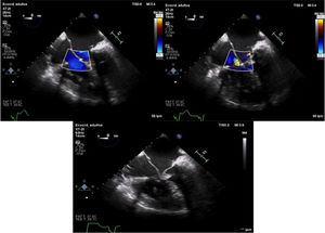 Imagen de ecocardiografía transesofágica intraoperatoria tras la reparación donde se objetiva clara disminución de la dilatación de cavidades derechas. El examen por doppler color muestra ausencia de gradiente significativo e insuficiencia leve de ambas válvulas AV.