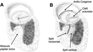 A) Esquema de la válvula AV izquierda con hendidura y músculo papilar único. B) esquema de la reparación. Se representa el split horizontal y vertical de los músculos papilares, así como el cierre del cleft y la anuloplastia posterior con anillo protésico.
