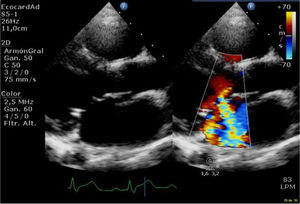 Insuficiencia severa mitral en ecocardiograma transtorácico preoperatorio, eje largo.