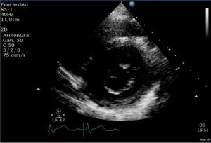 Hendidura mitral en ecocardiograma transtorácico preoperatorio, eje corto.