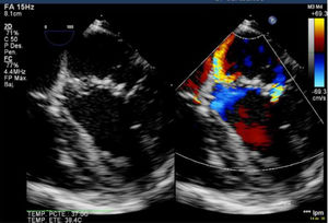 Persistencia de IM en base del cleft mitral en ecocardiograma transesofágico intraoperatorio.