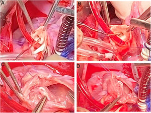 A y B) El probador marca la arteria coronaria derecha que está en íntimo contacto con la fístula. C y D) El orificio distal en la orejuela se sutura.