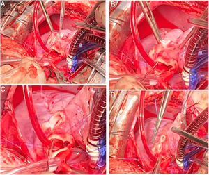 A y B) El túnel se secciona en su tramo medio. C) Se deja suficiente margen de pared arterial para cierre directo sin parche. D) Sutura directa de la pared del seno de Valsalva.