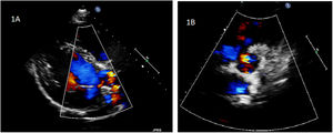 Ecografía transtorácica: a) proyección de eje largo en el que se visualiza la insuficiencia valvular severa mediada por 2 jets, uno central y otro excéntrico, de la neoválvula aórtica; b) eje corto.