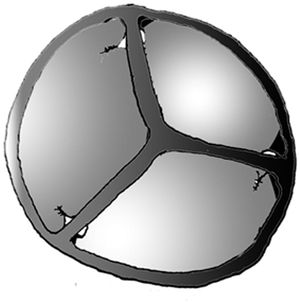 Ilustración. Vista del cirujano en la que se aprecia la sutura subcomisural de Cabrol utilizada para aumentar el área valvular efectiva.