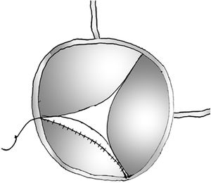 Ilustración. Vista del cirujano en la que se aprecia la técnica de ampliación del velo no coronario utilizando un parche de pericardio bovino anastomosado al borde libre del velo mediante una sutura continua de Prolene® 7/0.