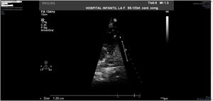 Medición preoperatoria del anillo pulmonar nativo (12,5 mm) (z-score = -3,4).