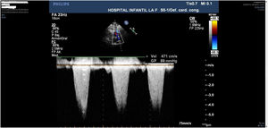 Gradiente preoperatorio muy elevado en TSVD.