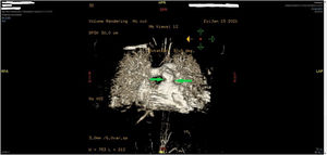 Imagen procesada de la cardio-RMN preoperatoria mostrando el rodete fibromuscular (flechas) inmediatamente por debajo del anillo pulmonar nativo preservado.