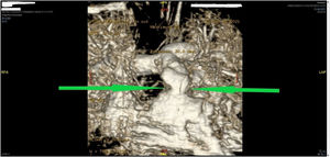 Imagen procesada de cardio-RMN (ampliada) mostrando el rodete fibromuscular (flechas) inmediatamente por debajo del anillo pulmonar nativo preservado que fue resecado durante la reoperación.