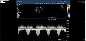 Último control ecocardiográfico postoperatorio (cinco meses) mostrando un gradiente residual leve en TSVD similar al control postoperatorio inmediato.
