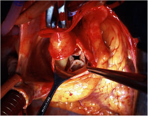 Imagen intraoperatoria. Aorta ascendente pinzada y aortotomía transversa. Se aprecia la válvula aórtica con cuatro cúspides y falta de coaptación central.