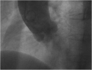 Aortografía en proyección oblicua anterior izquierda. Se aprecian cuatro senos.