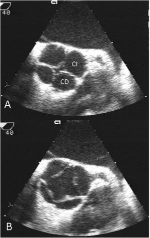 Ecocardiografía transesofágica de la válvula aórtica en eje corto. A)diástole; B)sístole. CD: seno coronariano derecho; CI: seno coronariano izquierdo.