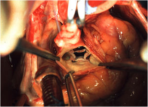 Imagen intraoperatoria. Aorta ascendente pinzada y aortotomía transversa. Se aprecia válvula aórtica con cuatro cúspides y falta de coaptación central.
