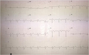 Electrocardiograma realizado al ingreso hospitalario.