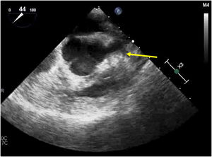 Ecocardiograma transesofágico. Se muestra un eje corto a nivel de grandes vasos en donde se puede observar la dilatación del seno de Valsalva izquierdo.