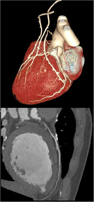 Angiotomografía del sistema coronario izquierdo (reconstrucción 3 D). Se muestra que los injertos arteriales tienen permeabilidad adecuada con adecuado paso de medio de contraste.