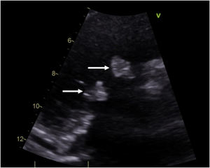 Diagnostic by echocardiography, arrows indicate tricuspid vegetations.