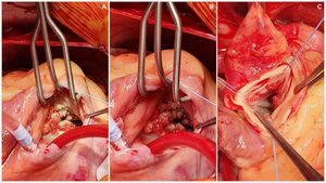 Direct view of vegetations in aortic and tricuspid valves.