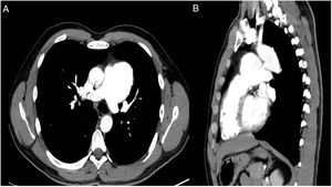 Contrast enhanced multislice chest CT (A) axial and (B) sagittal slices, showing an aneurysmal dilation arising from the pulmonary artery and wide patent ductus arteriosus.