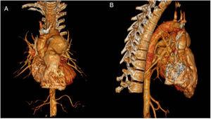 Three-dimensional reconstruction from the chest showing: dilated pulmonary trunk.