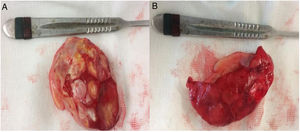 Specimen resected shown in the anterior (A) and posterior (B) view, measuring 7×6cm.