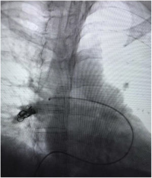 Pulmonary angiogram, demonstrate occluded right lower lobe segmental arteries.