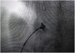 The coil nest was then pulled down into the left external iliac vein.