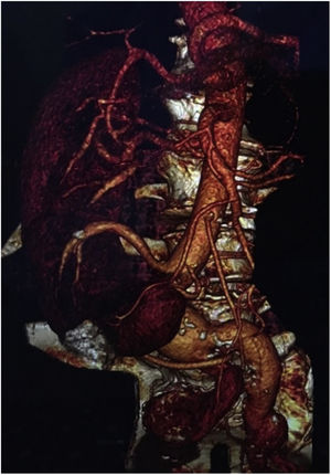 Aorto-iliac aneurysm with right orthotopic kidney and crossed ectopic kidney. Crossed renal arteries, superior emerging from the neck of the aneurysm and inferior from the left common iliac artery.