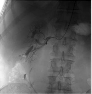 Selective angiography of the right orthotopic kidney.