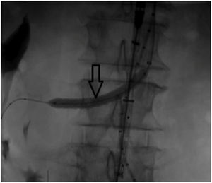 Arrow, chimney. Viabahn stent graft (5mm×150mm; Gore Medical, Flagstaff, Ariz) was released in the main crossed right renal artery, and a balloon (5mm×150mm; Pacific [Medtronic]) was positioned inside the stent graft.