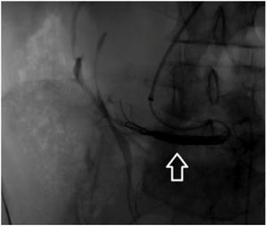 Non dominant crossed renal artery embolized with 2 Coils to avoid endoleaks (Concerto 20mm×40mm Medtronic, Minneapolis, Minn).