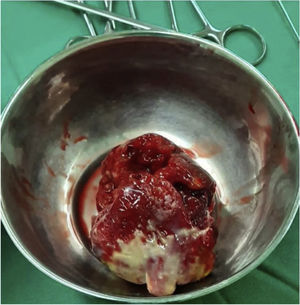 Pieza quirúrgica: tumor auricular izquierdo con pedículo.
