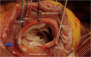 Tricuspid valve annuloplasty.