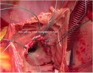 modified De Vega using pericardial patch.