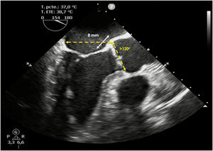 Medidas sugeridas en el análisis preoperatorio. La cortina mitro-aórtica debe medir, al menos 8 mm de longitud9. Recomendamos que el ángulo formado por los planos de las válvulas mitral y aórtica sea superior a 120°.