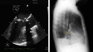A la izquierda (flecha blanca), sombra acústica que produce el stent situado por debajo de la válvula aórtica. A la derecha, imagen radiográfica de perfil que muestra la posición de ambas válvulas, mitral y aórtica (flechas amarilla y azul, respectivamente).