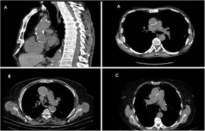 Imágenes de tres pacientes intervenidos, que presentaban importantes placas de calcio. Las dos imágenes superiores corresponden al mismo paciente. La válvula de anclaje rápido EDWARDS INTUITY Elite permite menor manipulación del anillo aórtico y de las paredes de la raíz de la aorta, y reduce la posibilidad de que las placas se desprendan.