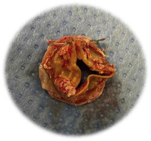 Prótesis Trifecta™ degenerada. Bioprótesis aórtica Trifecta™ explantada por degeneración precoz. Pueden observarse engrosamiento y calcificación de los velos valvulares.