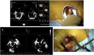 Implante de la prótesis TendyneTM. A) «Finger test» a nivel del ápex. B) Prótesis Tendyne™ implantada (flecha roja). C) «Apical Pad». Almohadilla apical de la prótesis Tendyne™.