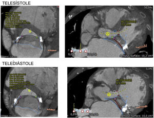 Planificación preoperatoria TC cardiaca multifase. Reconstrucción del anillo mitral y del tracto de salida del ventrículo izquierdo en sístole y diástole como parte del estudio de planificación preoperatoria de implante de TendyneTM.