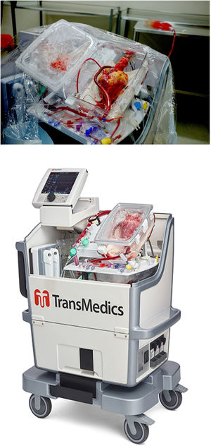Organ Care System (OCSTM) de TransMedics. Arriba: corazón conectado al dispositivo y el sistema para la realización de la perfusión normotérmica ex vivo. Abajo: dispositivo portátil con monitor inalámbrico y módulo de perfusión.