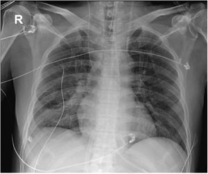 Radiografía de tórax AP en decúbito donde se observa la cánula ProtekSolo® en aurícula izquierda y tras ser colocada vía transeptal.