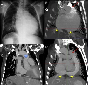 Mujer de 40 años, heterotaxia con situs inversus abdominal, y ventrículo único con doble fístula sistémico-pulmonar. Previamente al trasplante observamos en (A) la radiografía de tórax, y en (B) imagen de tomografía computarizada que muestra aurícula común con drenaje independiente de suprahepáticas (★) y ausencia de vena cava inferior con continuidad hemiácigos-vena cava superior izquierda (flecha). Imágenes de tomografía computarizada postrasplante muestran (C) pedículo largo para empatar la aorta (corazón), y reconstrucción del drenaje venoso sistémico (D) con conducto de gore-tex® desde la cava superior izquierda hasta la cava inferior del corazón donante con anastomosis latero-lateral de las suprahepáticas.
