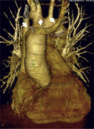 Mujer de 19 años con heterotaxia, ventrículo único con canal auriculoventricular disbalanceado y doble vena cava superior sin innominada. Imagen de tomografía computarizada que muestra reconstrucción tridimensional postoperatoria del corazón trasplantado; las flechas muestran la innominada del donante usada para suturarla con la vena cava superior izquierda de la receptora.