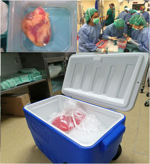 Trasporte tradicional del corazón donado. Arriba: corazón en el recipiente donde se prepara y se introduce con la solución de preservación. Abajo: nevera con hielo pilé donde se transporta el órgano envuelto en tres bolsas estériles.